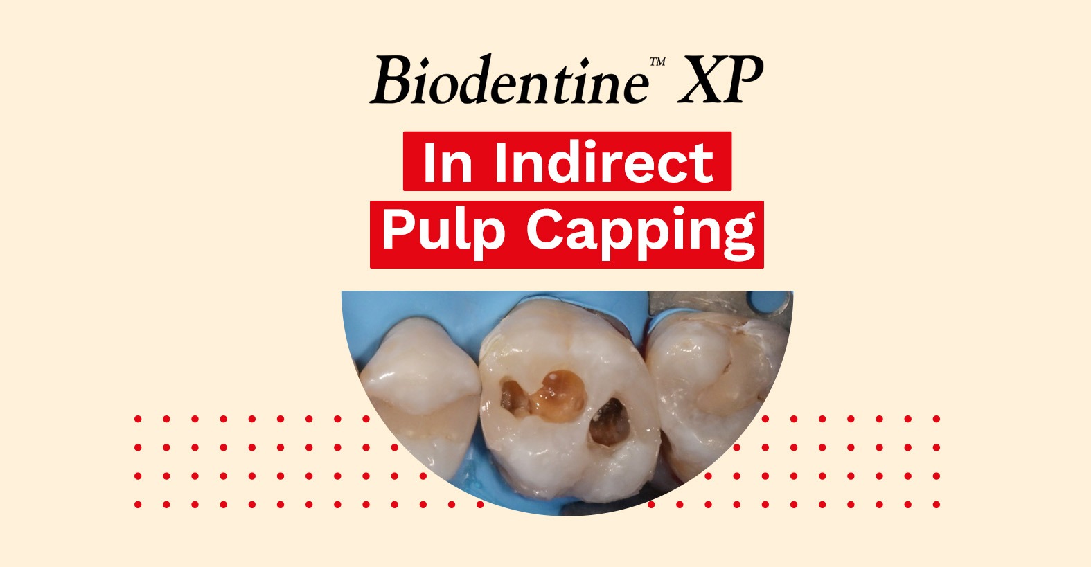 Indirect Pulp Capping - Dr Ganowicz - Septodont UK